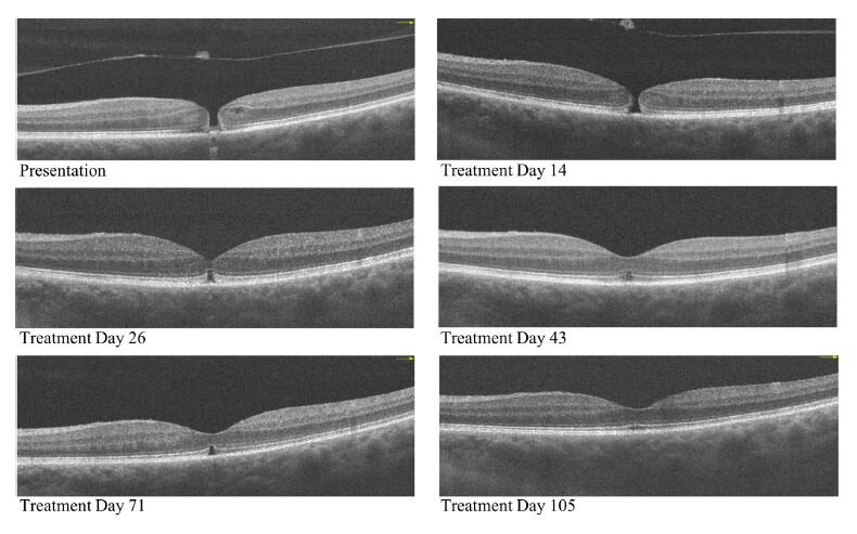 Macular Hole Treatment Images