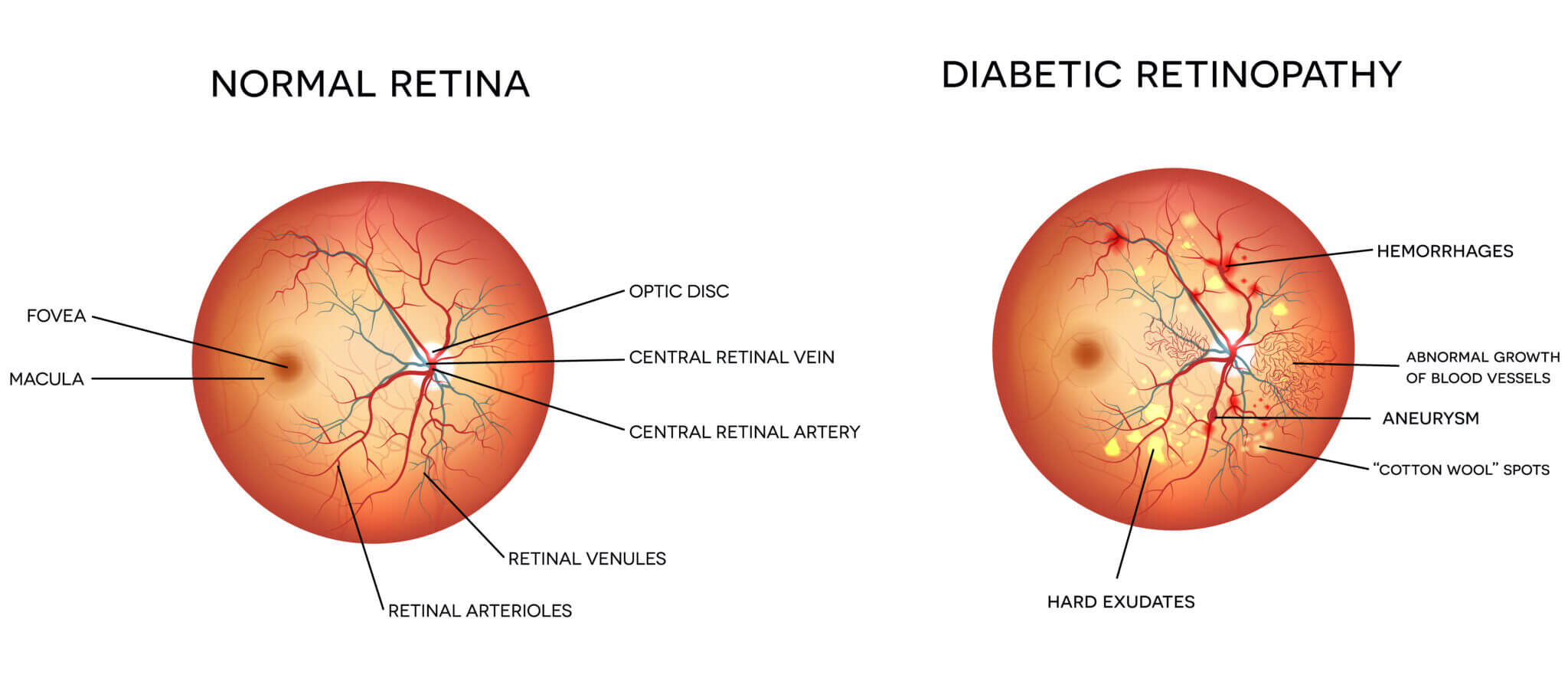 Diabetic Eye Disease Chicago Diabetic Eye Exam Bedford Park
