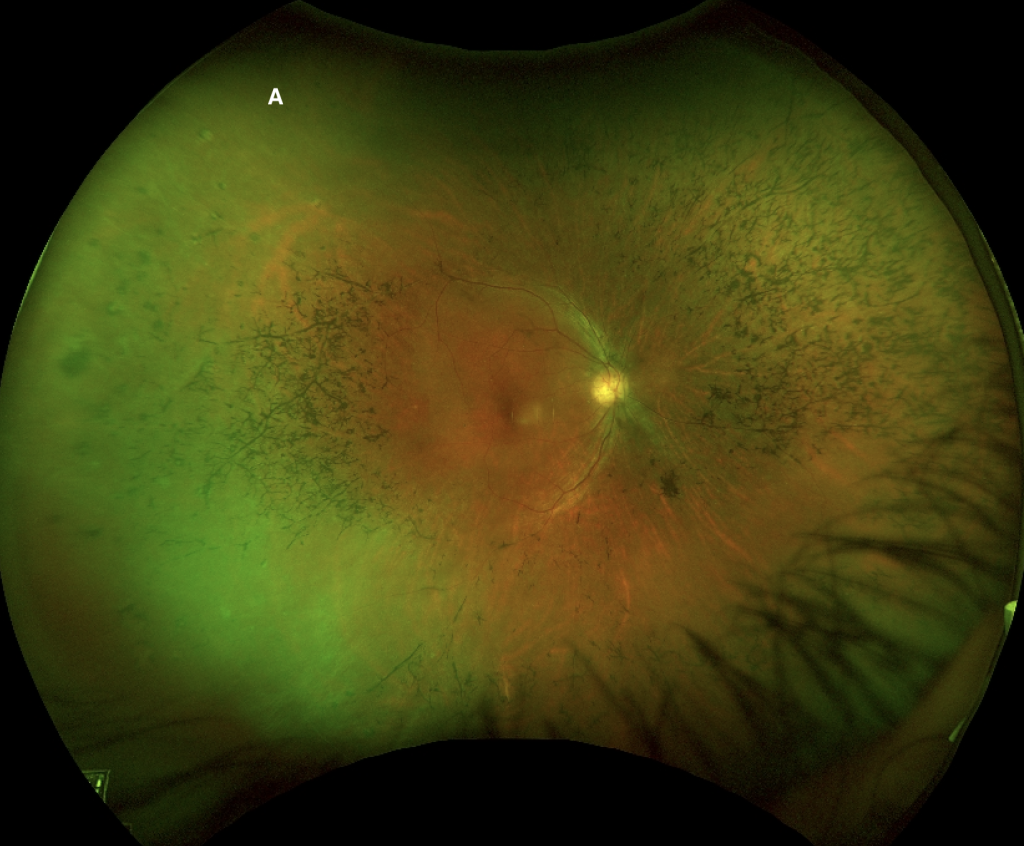Figure 1a: Wide-field fundus photograph of the right (A) eye. Note the significant bone spicules, vascular attenuated, and optic disc pallor in both eyes.