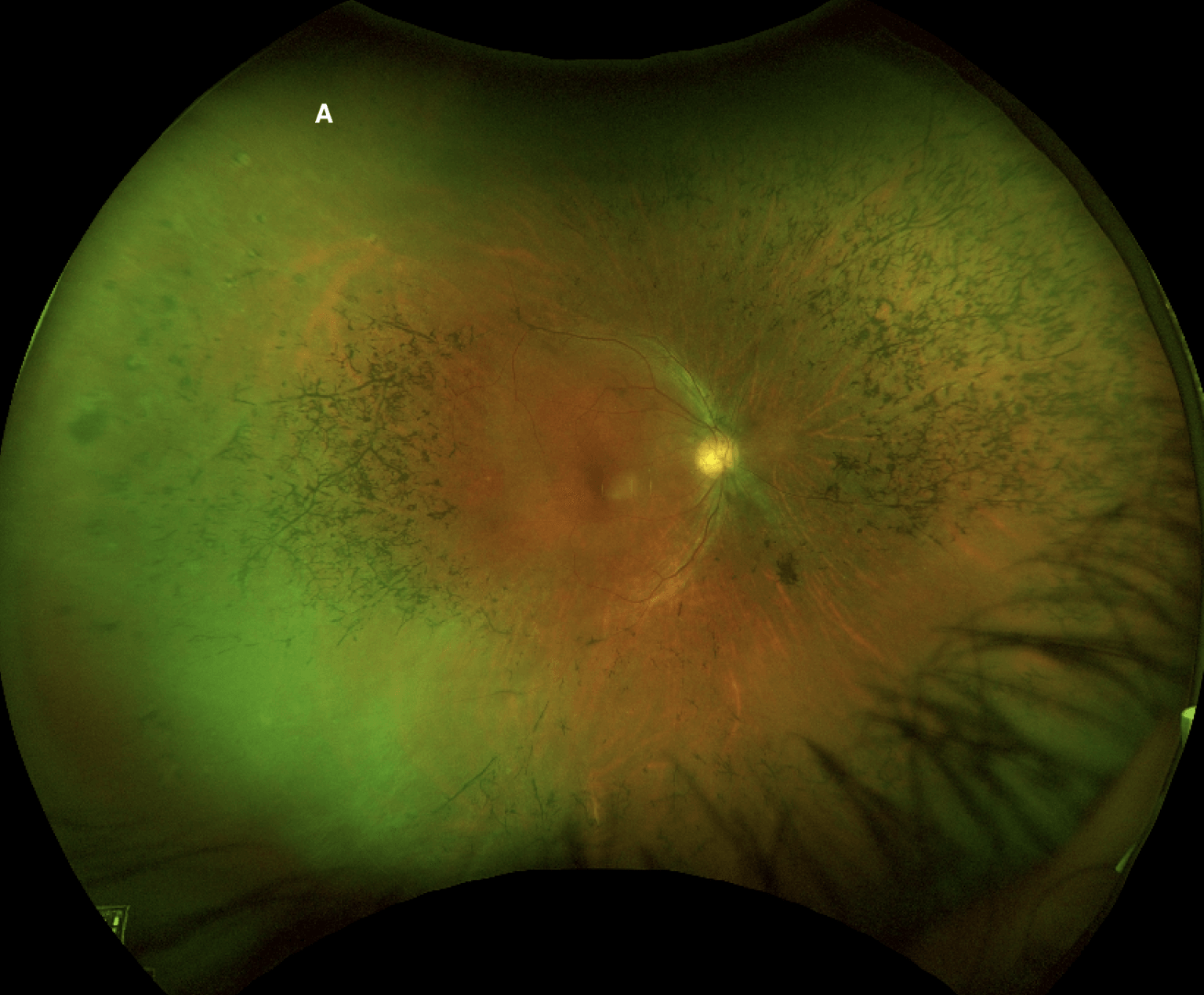 Spotlight Case | Retinitis Pigmentosa Chicago | University Retina